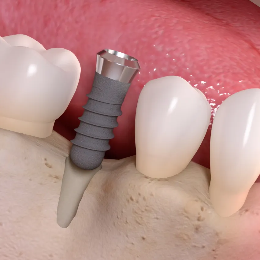 Zahnimplantat München